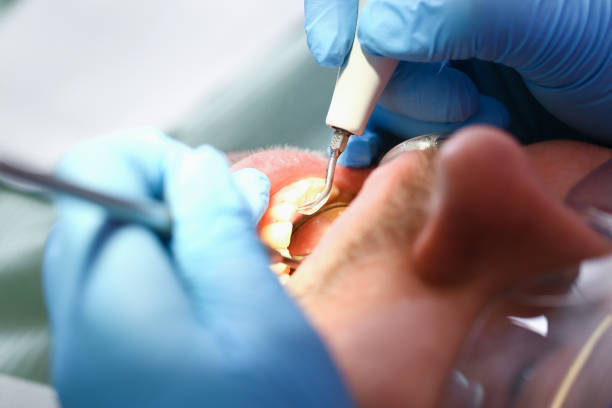 Best Emergency Root Canal Therapy in Largo, MD